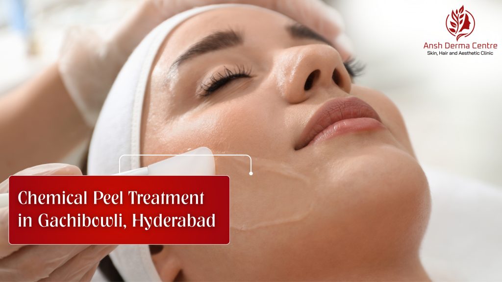 Chemical Peel Treatment in Gachibowli