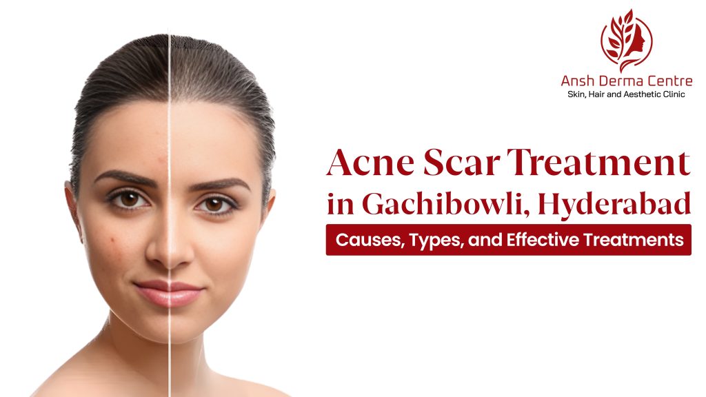 Acne Scar Treatment in Gachibowli