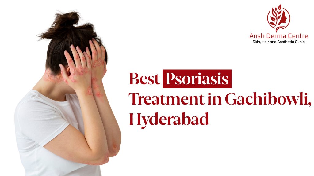 Best Psoriasis Treatment in Gachibowli