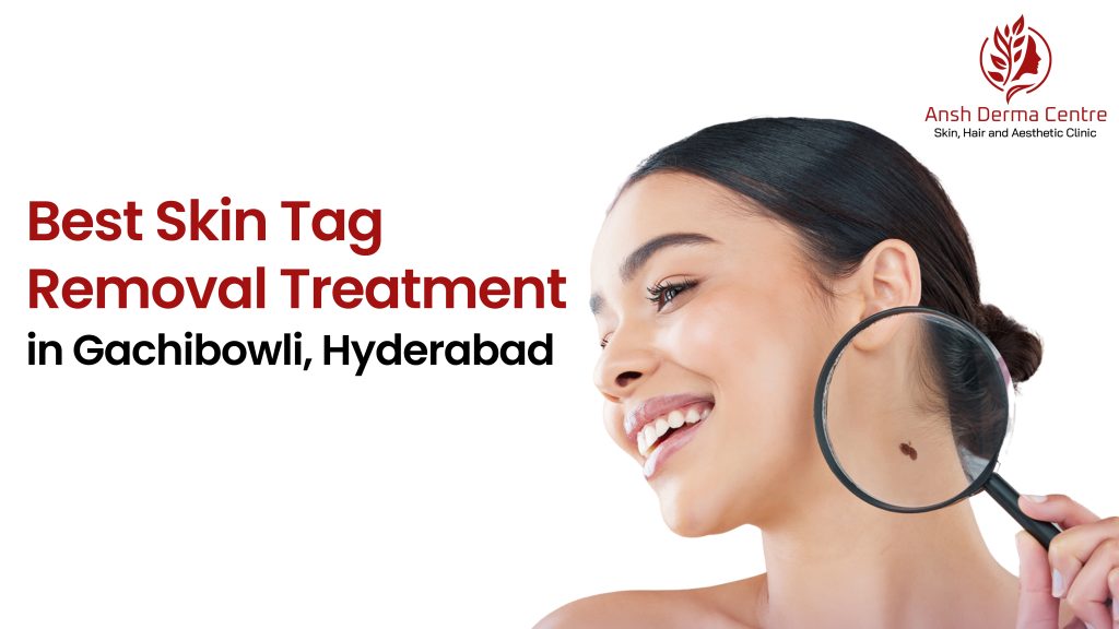 Best Skin Tag Removal Treatment in Gachibowli