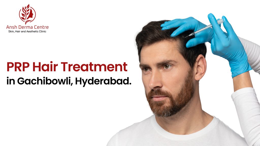 PRP Hair Treatment in Gachibowli