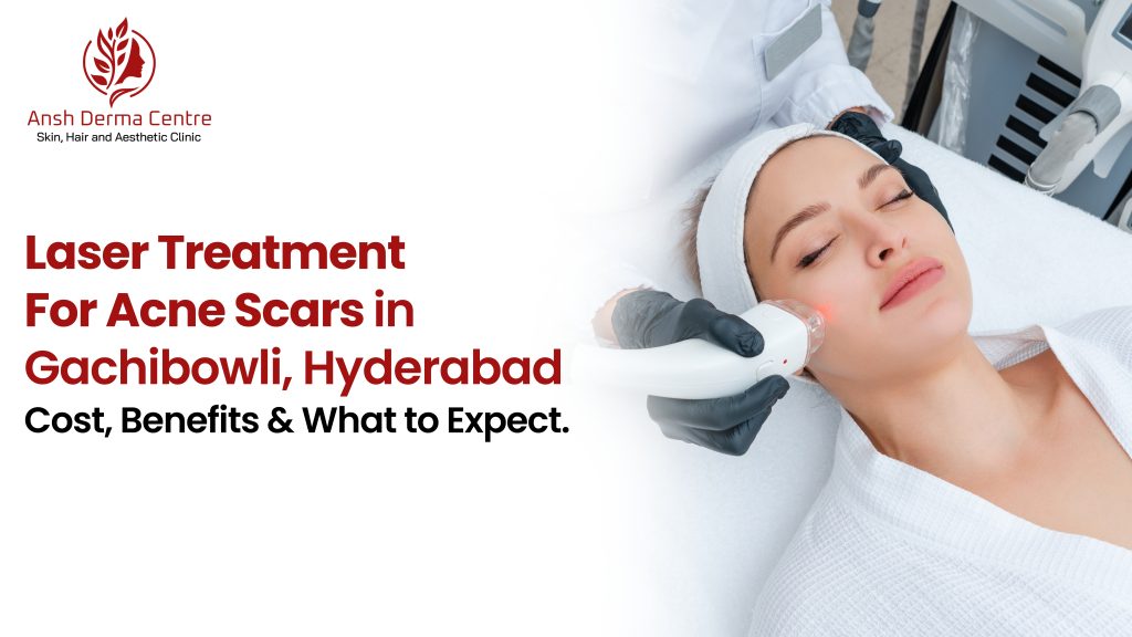 Laser Treatment for Acne Scars in Gachibowli