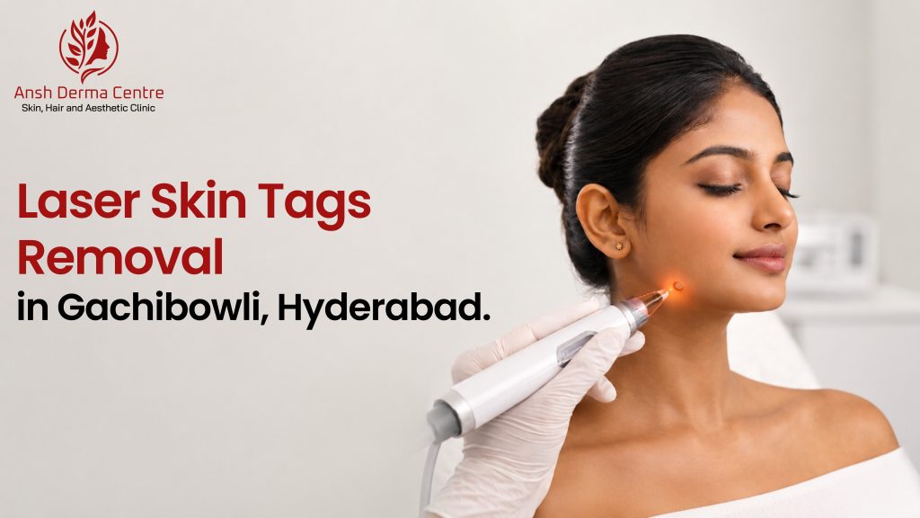 Laser Skin Tags Removal in Gachibowli