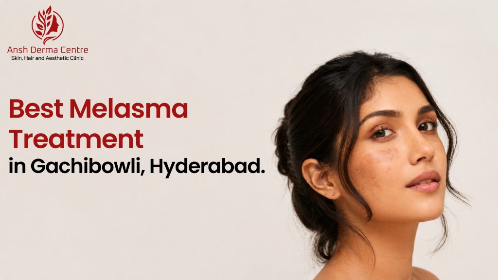 Best Melasma Treatment in Gachibowli