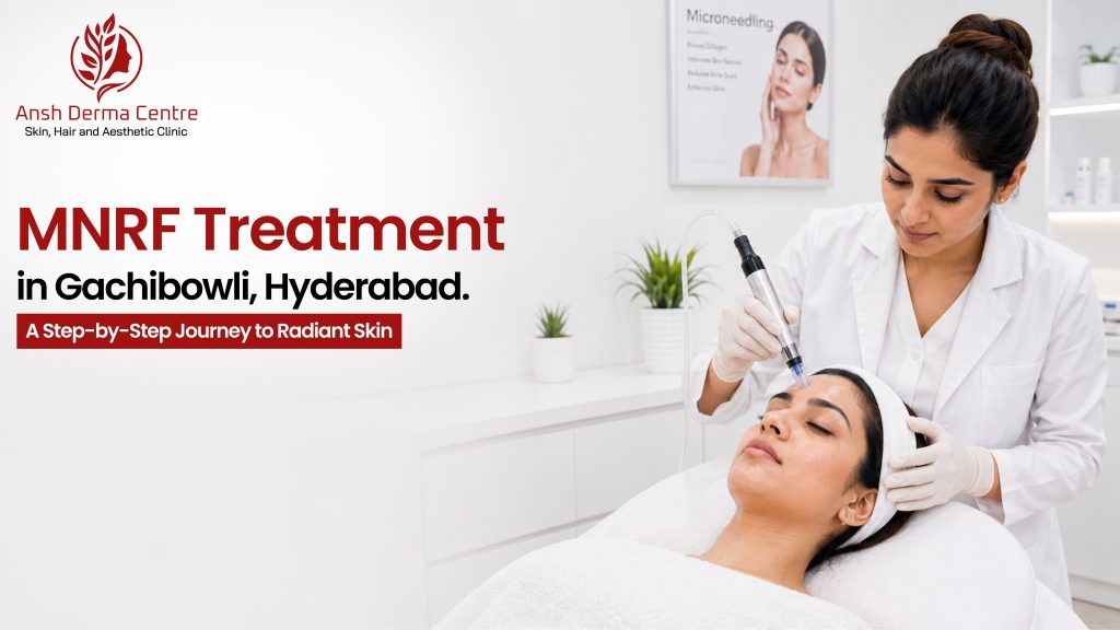 MNRF treatment in Gachibowli