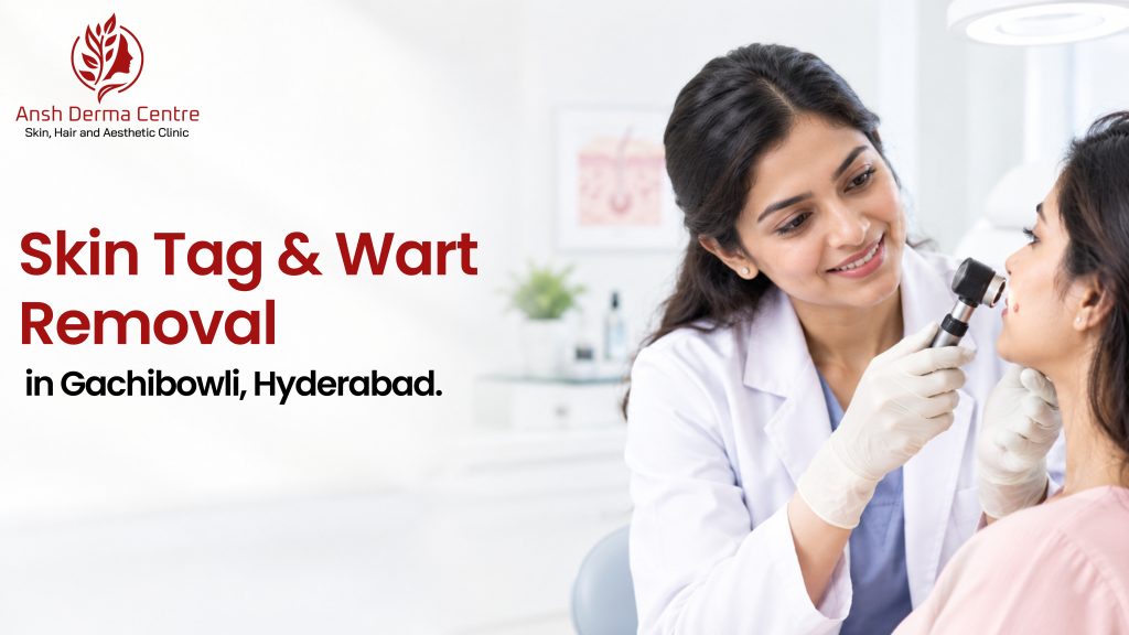 Skin Tag & Wart Removal in Gachibowli