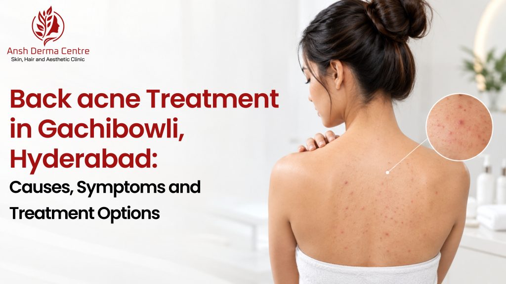 Back Acne Treatment in Gachibowli