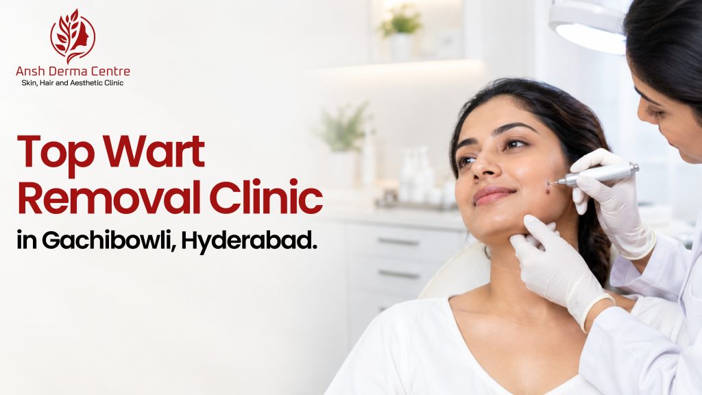 Top Wart Removal Clinic in Gachibowli