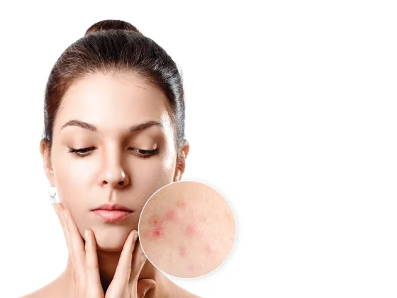 acne - Expert Dermatology Services