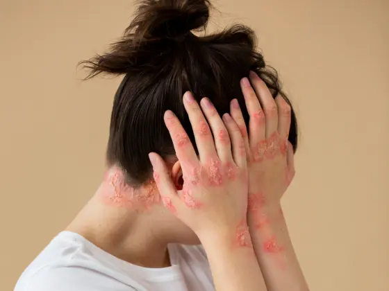 psoriasis - Expert Dermatology Services