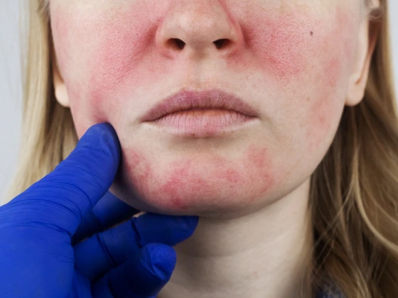 rosacea - Expert Dermatology Services
